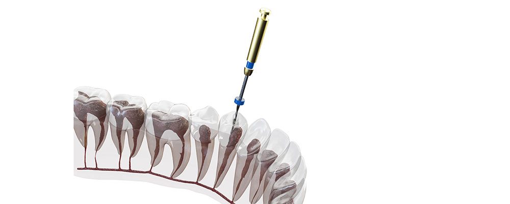 重度のむし歯は根管治療を行います